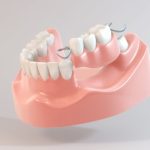 インプラントと入れ歯の比較｜メリット・デメリット