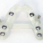 インプラント治療の精度を高めるサージカルガイドって知ってる?