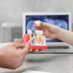 インプラントのメリットや注意点、治療検討に重要なポイント