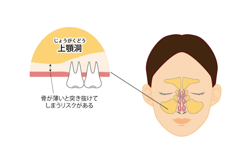 上顎のインプラントは難しい・危険なのか?上顎洞炎の危険性についても解説 | 長崎でインプラントなら「渡辺歯科医院」