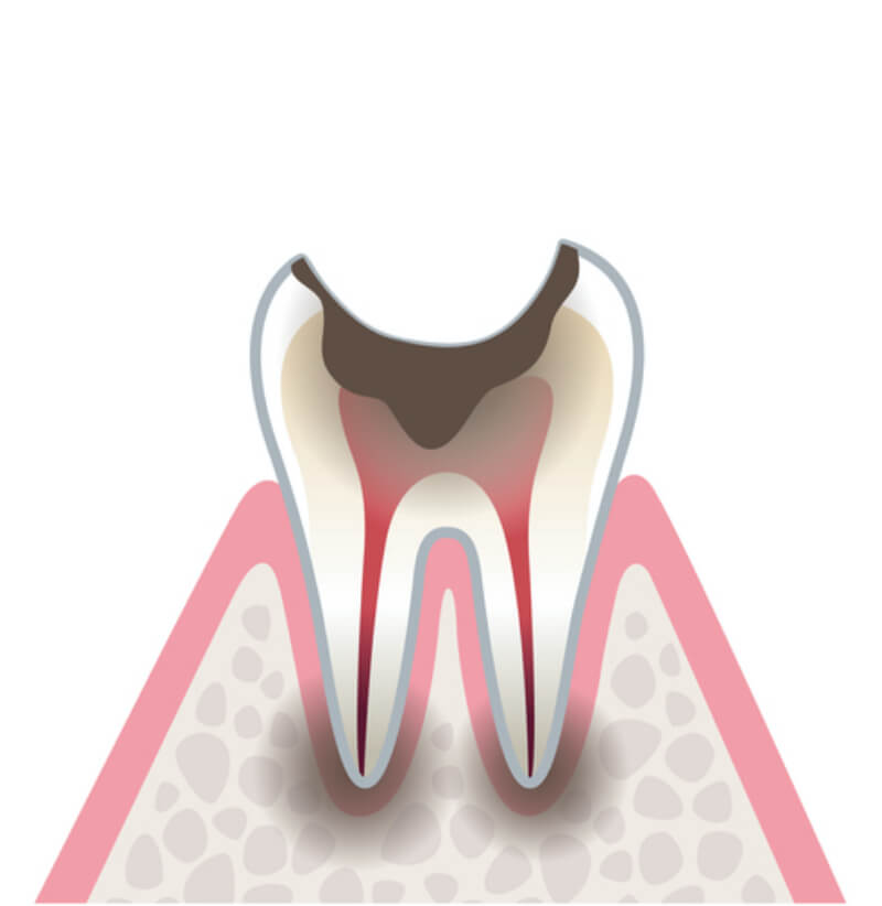 虫歯の進行C4