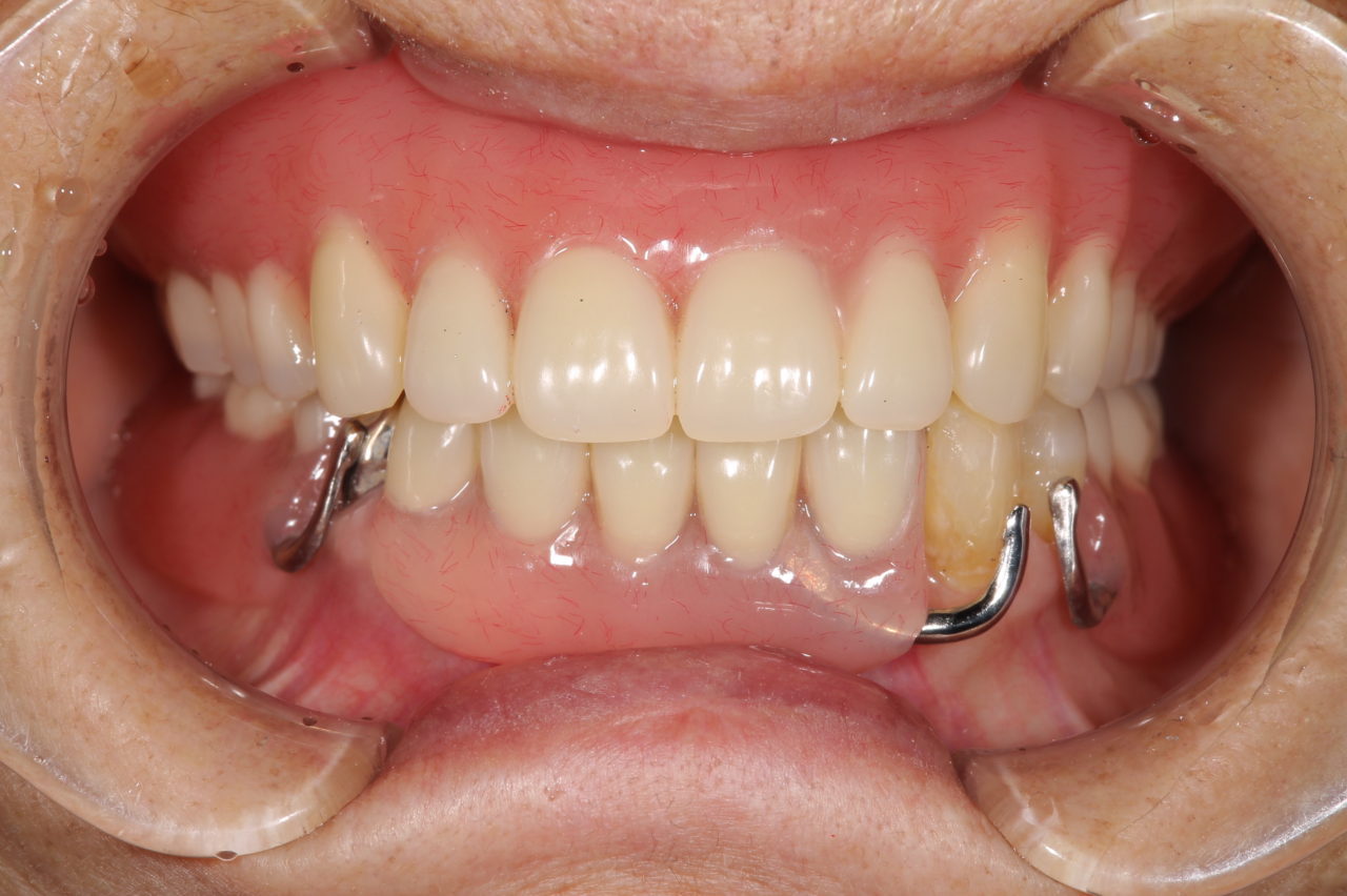 右下のブリッジの外し、保存不可の歯を抜歯した。<br />
その後上下義歯を新製した。処置後