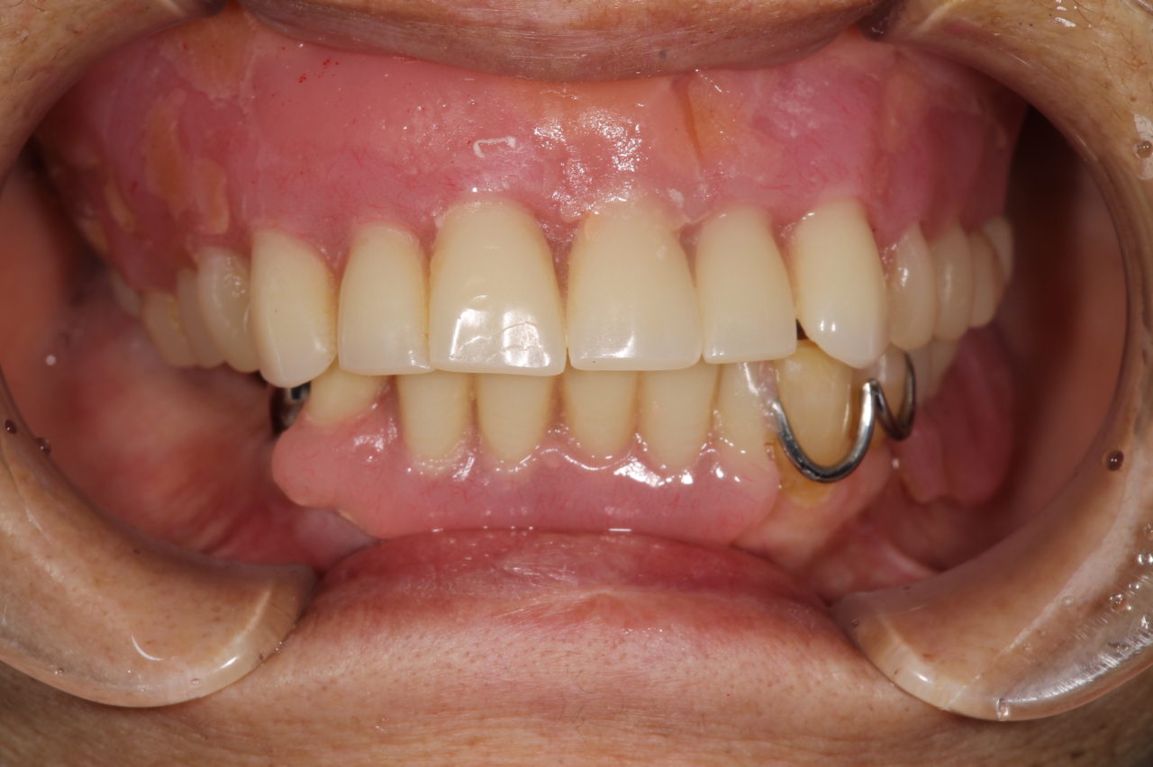 右下のブリッジの外し、保存不可の歯を抜歯した。<br />
その後上下義歯を新製した。処置前