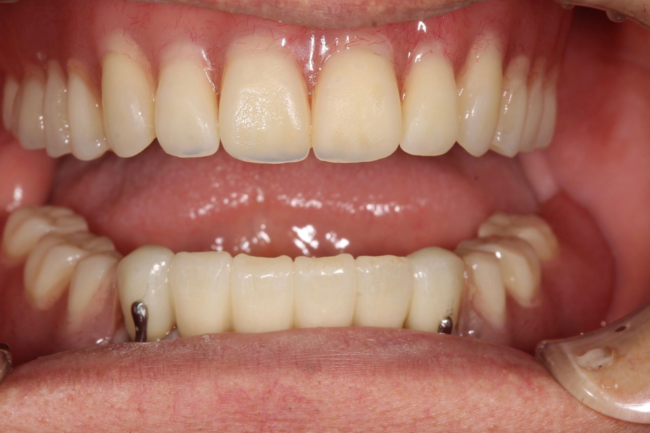 上顎　総義歯金属床<br />
下顎　部分義歯<br />
下顎前歯　セラミッククラウン処置後