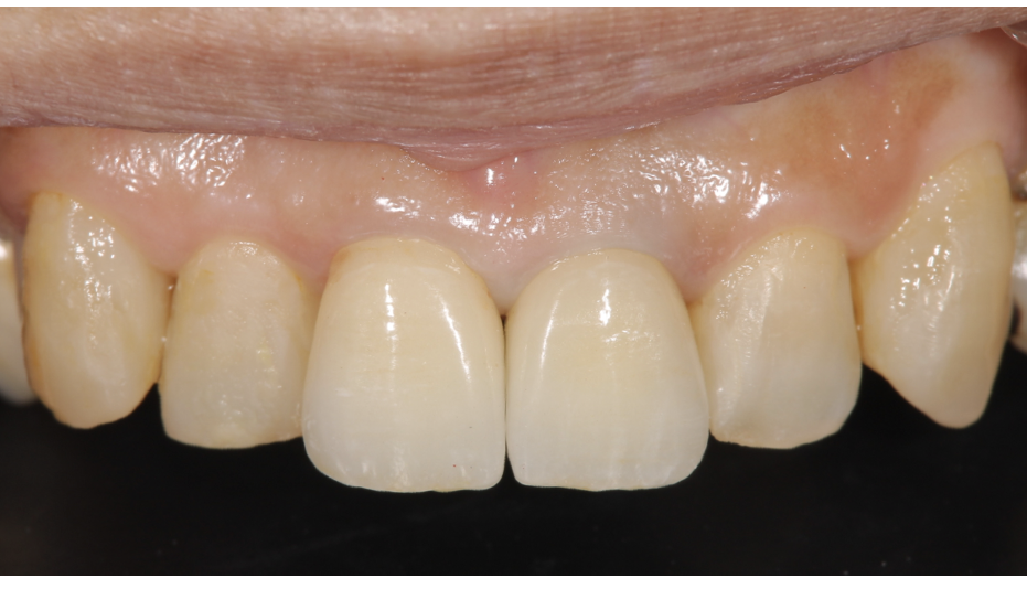 上顎前歯　セラミック（二ケイ酸リチウム）<br />
<br />
前歯のクラウンをやりかえて、隣り合う歯（神経をとっている歯）をクラウンにした処置後