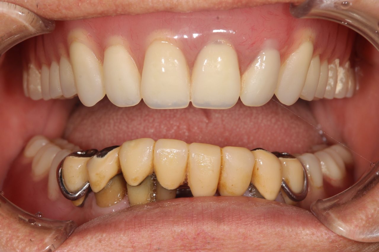上顎　総義歯金属床<br />
下顎　部分義歯<br />
下顎前歯　セラミッククラウン処置前